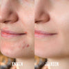 Valoterapia & aknehoitolaite DermaClear