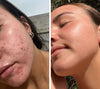LED-valoterapia kasvonaamio